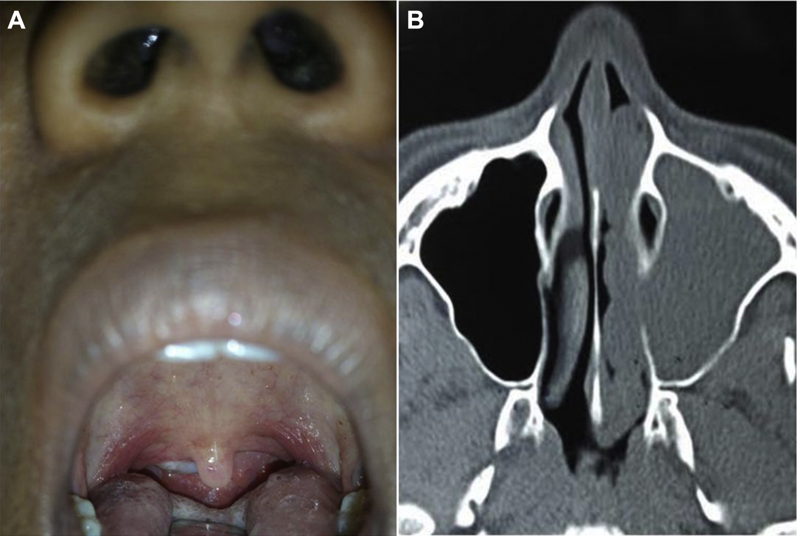 <p>What is an antrochoanal polyp?</p>