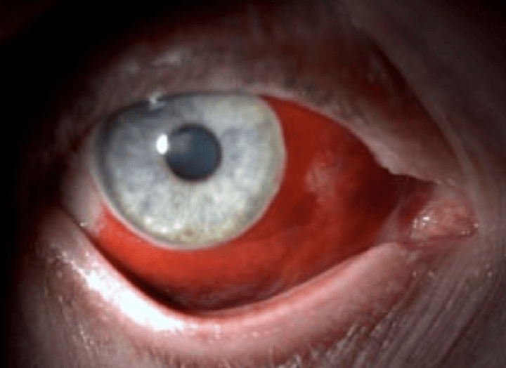<p>Blood in eye</p>