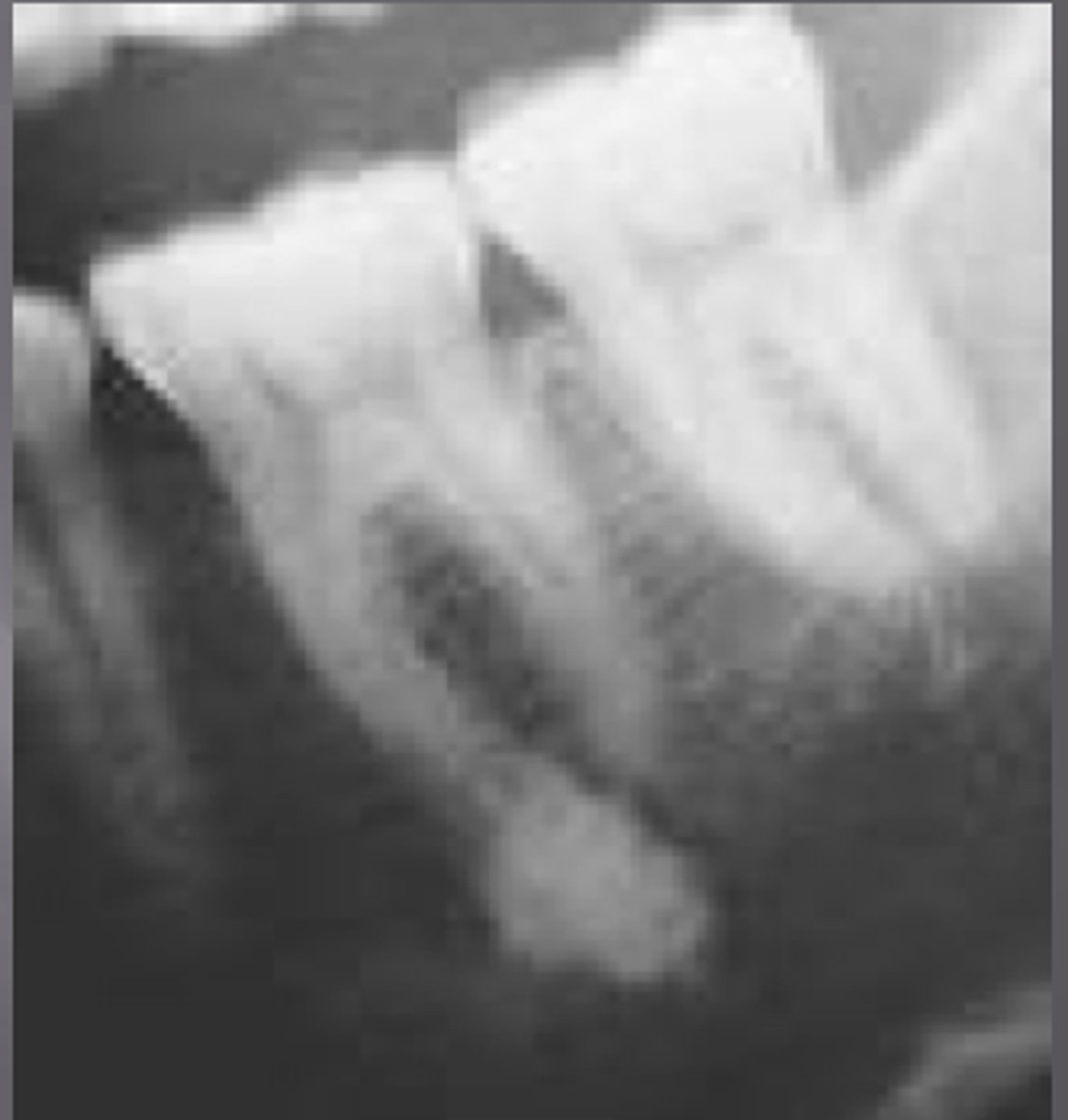 <p>well-defined, localized radiopaque lesion</p>