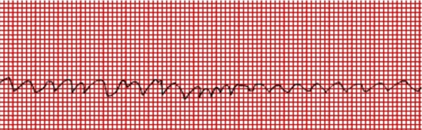 <p>Multiple foci within the ventricle become irritable and generate uncontrolled, chaotic impulses</p><p>quivering baseline</p>
