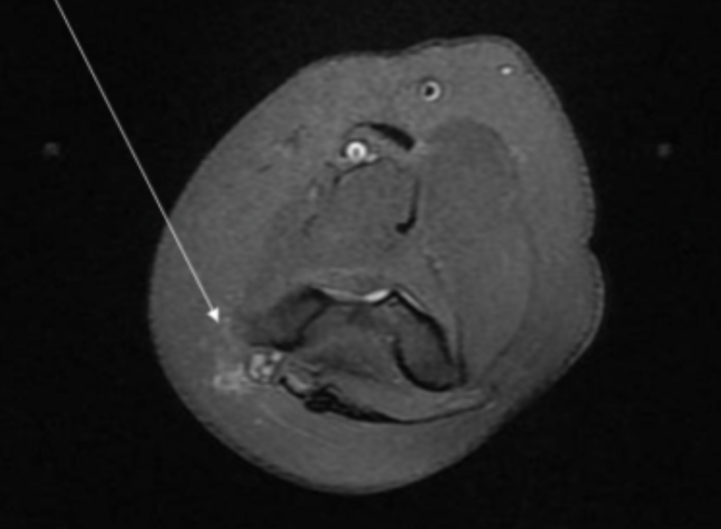 <p>Describe the pathology indicated by the arrow (Ax PD FS). </p>