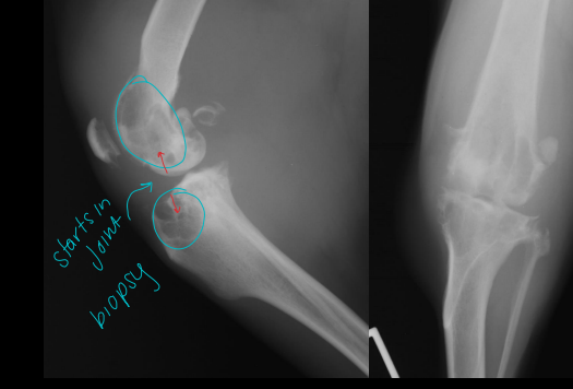 <p>Synovial Cell Sarcoma</p>