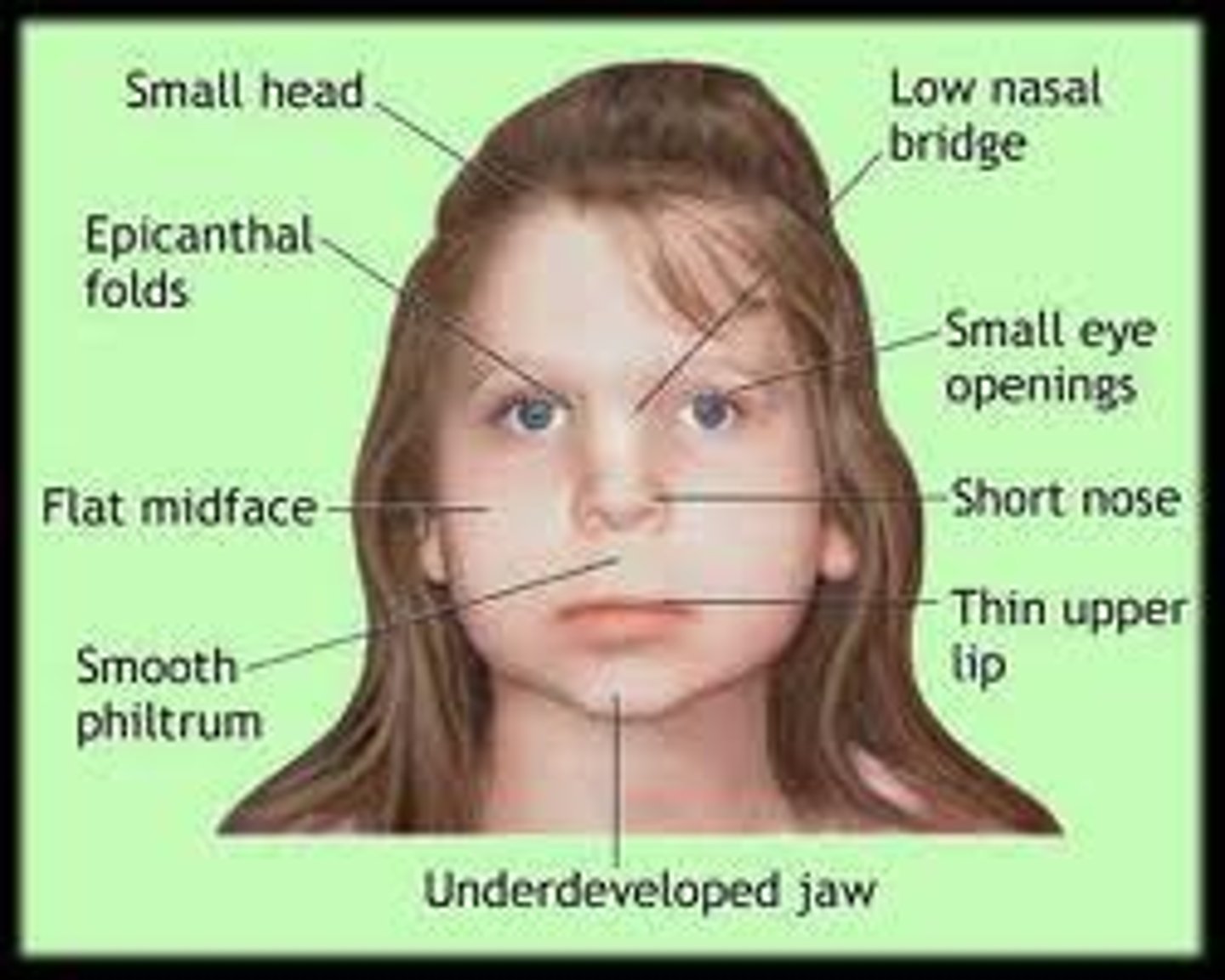 <p>physical and cognitive abnormalities in children caused by a pregnant woman's heavy drinking. In severe cases, symptoms include noticeable facial misproportions.</p>