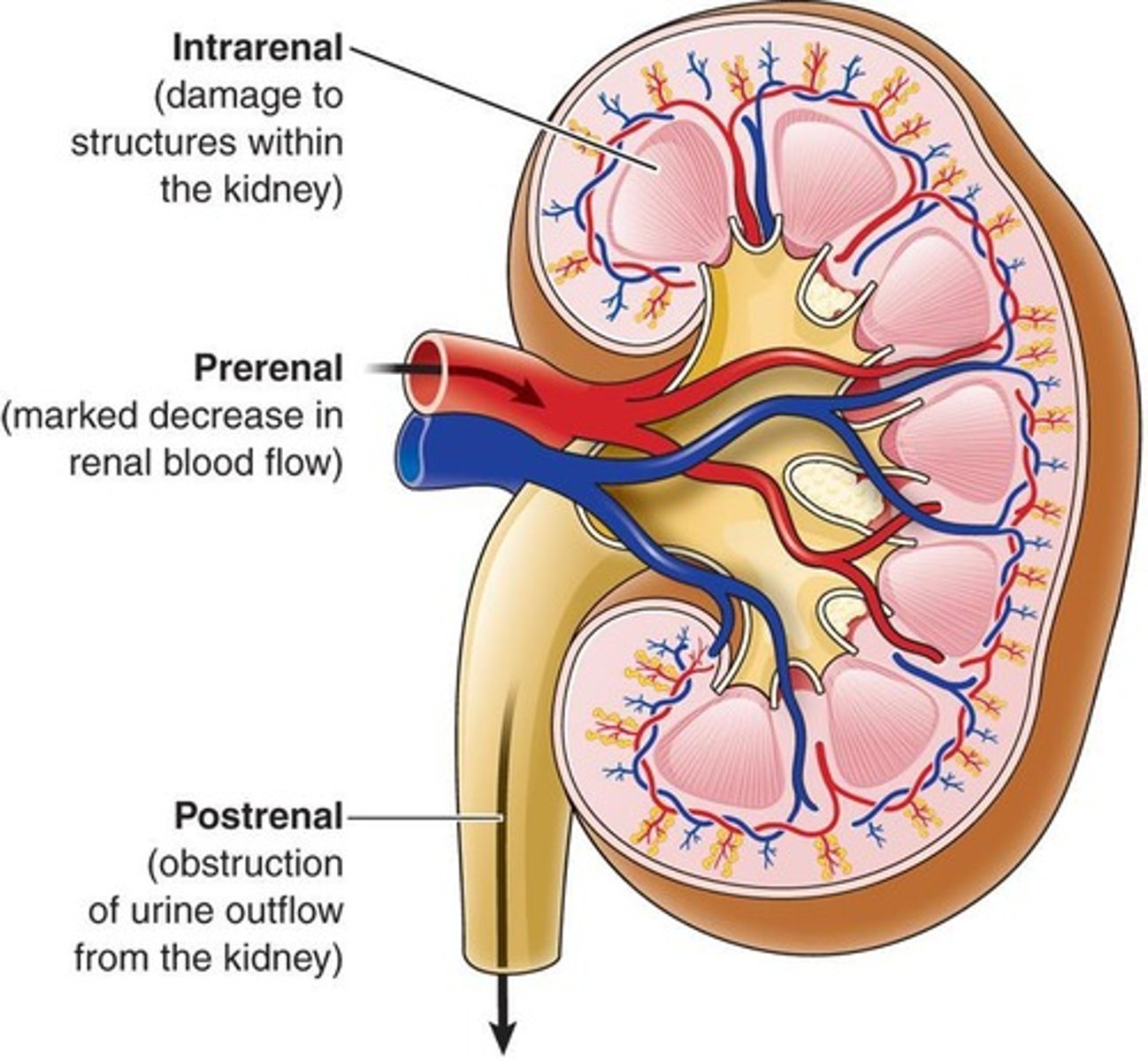 <p>Rapid decrease in kidney function.</p>