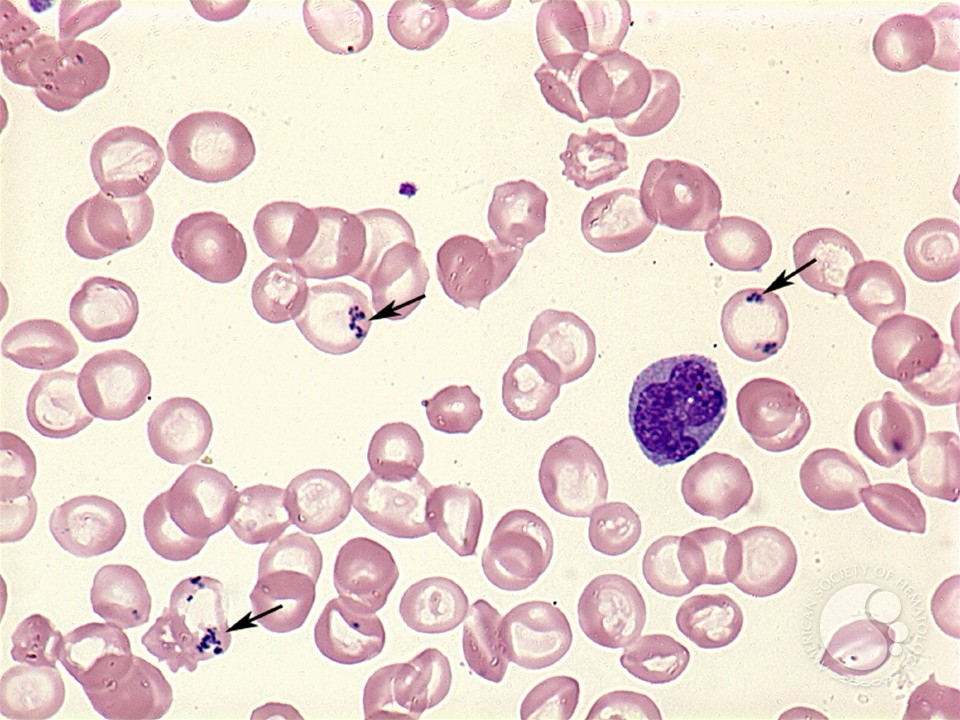<p>Abnormal basophilic iron granules inside the rbc</p>