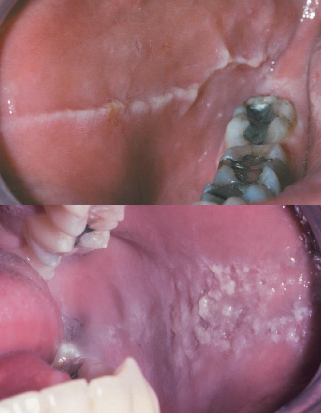 <p>which environmental/reactive lesion:</p><ul><li><p>Linea alba- buccal mucosa</p></li><li><p>Morsicatio mucosae oris- chronic chewing of the oral mucosa</p></li><li><p>Biopsy is rarely indicated</p></li><li><p>No treatment required</p></li></ul><p></p>