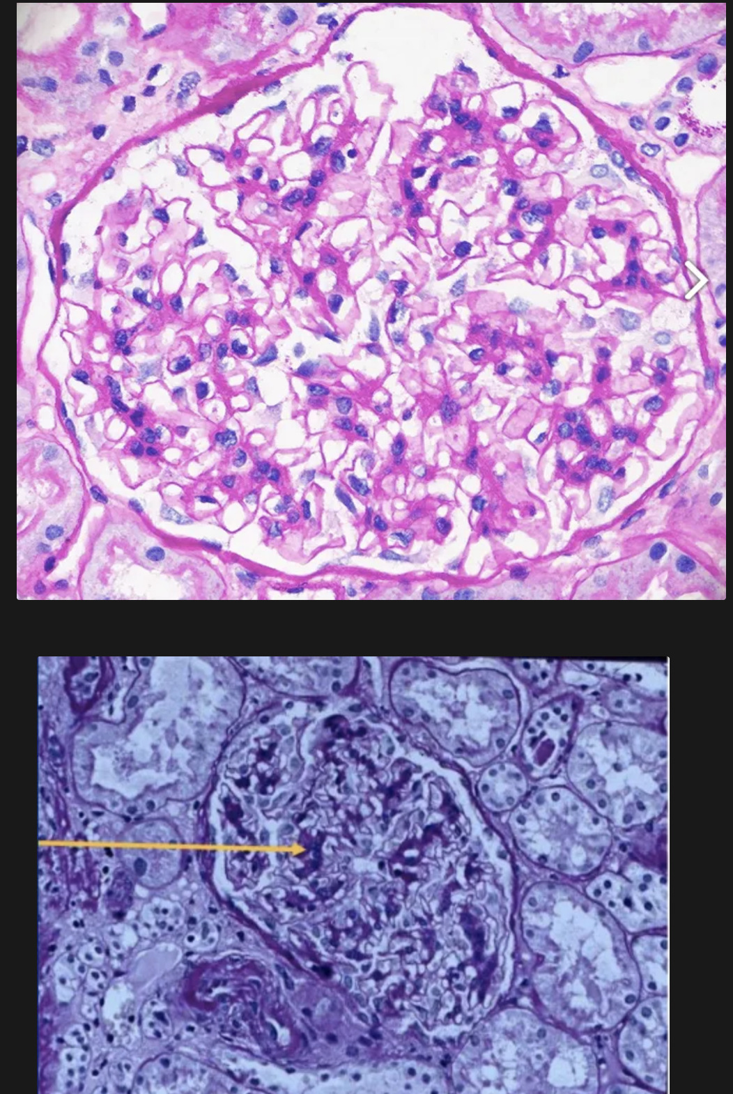 <p><strong>Nefritis Proliferativa Mesangial de clase 2</strong></p><ul><li><p>Proliferación de células mesangiales</p></li><li><p>Acumulación de matriz mesangial y depósitos mesangiales granulares de inmunoglobulinas y complemento sin afectación a capilares glomerulares</p></li></ul><p></p><p>Presentación clínica:</p><ul><li><p>Función renal normal</p></li><li><p>Rara vez hay síndrome nefrótico</p></li></ul><p></p>