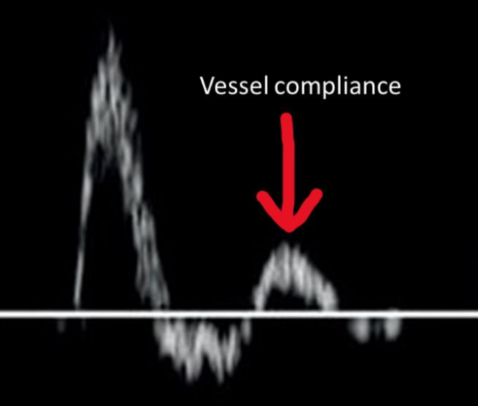 <p>flow patterns with ________________:</p><ul><li><p>energy stored in the distended artery is unable to overcome the high resistance downstream</p></li><li><p>flow occurs only in systole</p></li><li><p>triphasic flow patterns may result</p></li></ul>