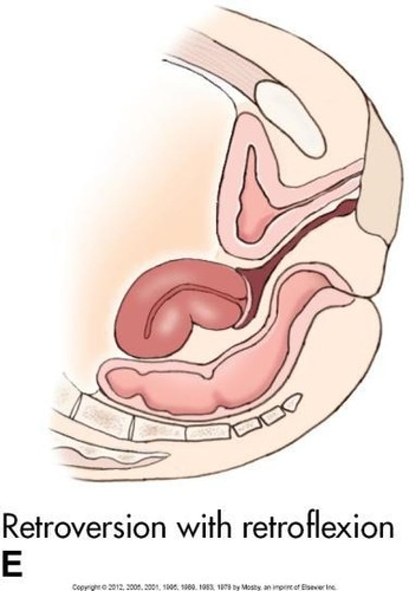 <p>Entire uterus tilted posteriorly.</p>