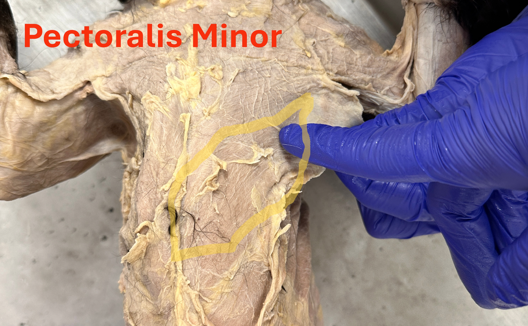 <p>Pectoralis minor (Anterior shoulder and chest)</p>
