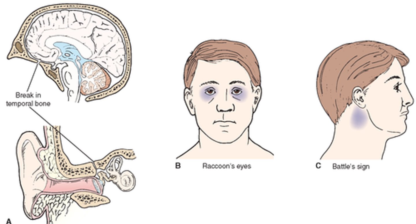 <p>1. Raccoon eyes</p><p>2. Battle sign- bruising behind ears</p>