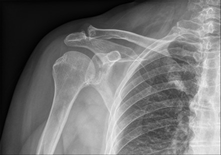 <p>Where is the fracture?</p>