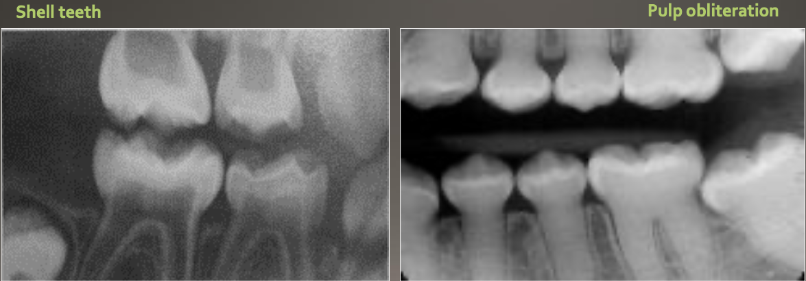 <ul><li><p>Bulbous crown</p></li><li><p>Cervical constriction</p></li><li><p>Pulp obliteration varies</p></li><li><p>Expanded pulp = shell teeth</p></li></ul><p></p>