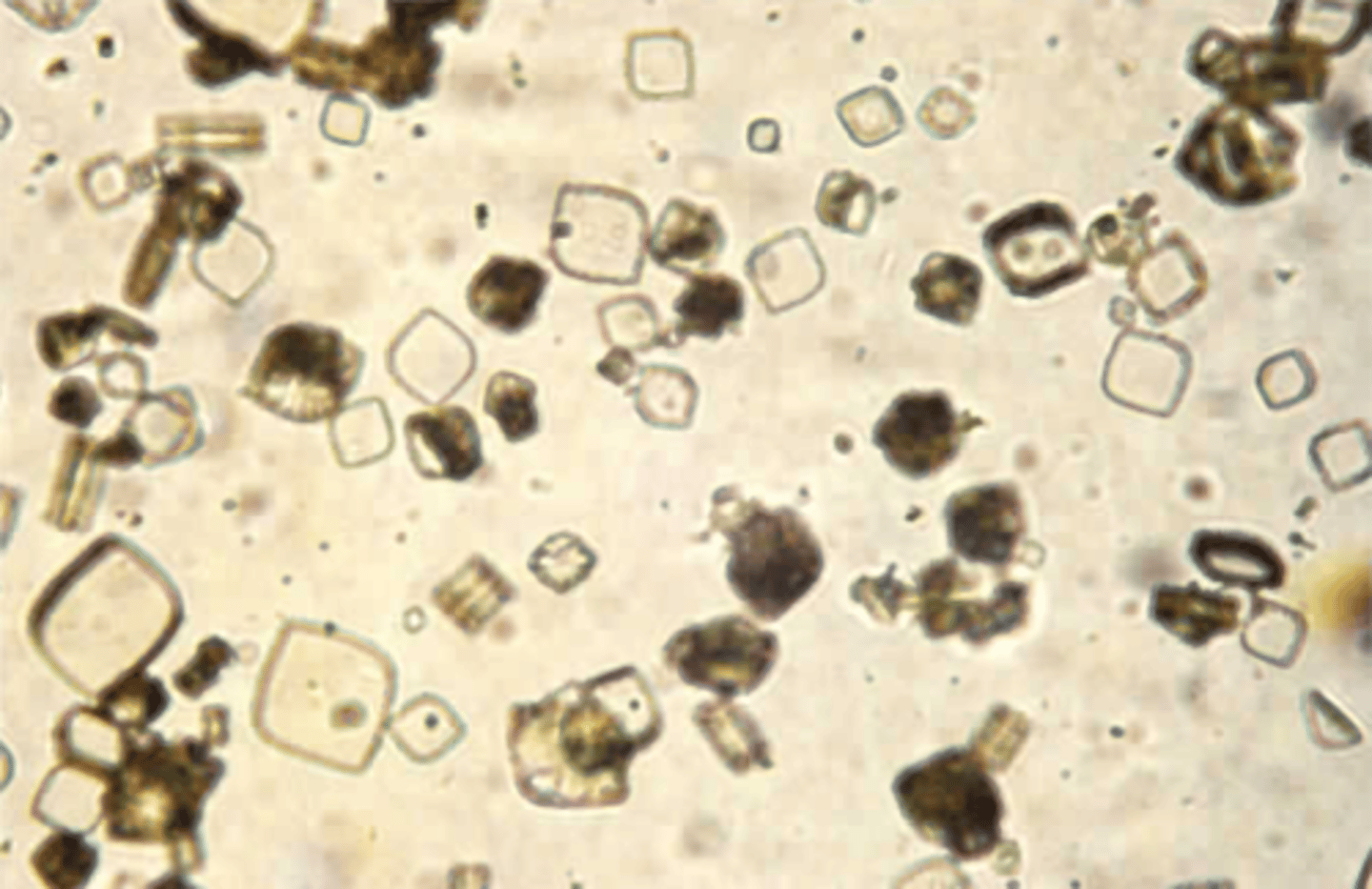 <p>B. Can also resemble cysteine crystals</p><p>Uric acid crystals, as seen in Color Plate 54,</p><p>are commonly encountered in normal acidic urine but may be observed in neutral urine and rarely in an alkaline urine, because uric acid is soluble at alkaline pH. Using brightfield microscopy, uric acid crystals appear as diamonds, cubes, barrels, rosettes, and may even have six sides and be confused</p><p>with cysteine.</p>