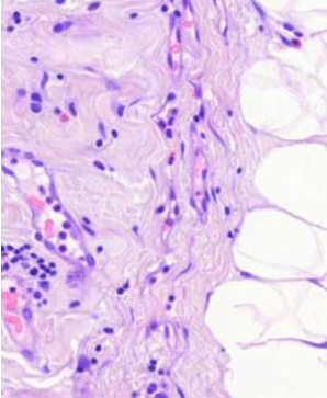 <p>mitä kuvassa näytetään? (vinkki: krooninen kolekystiitti)</p>