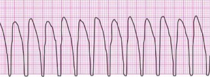 <p>3+ consecutive PVCs</p><p>may be sustained or non-sustained, w or w/o pulse</p><p>rhyth: regular</p><p>rate: 100-250 bpm</p><p>no P wave</p><p>no PR interval</p><p>QRS wide and abnormal</p><p>potential causes: electrolyte abnormality, ischemic heart disease, meds, hypoxemia</p><p>implications: significant impairment in CO, potential to degenerate to V fib</p>