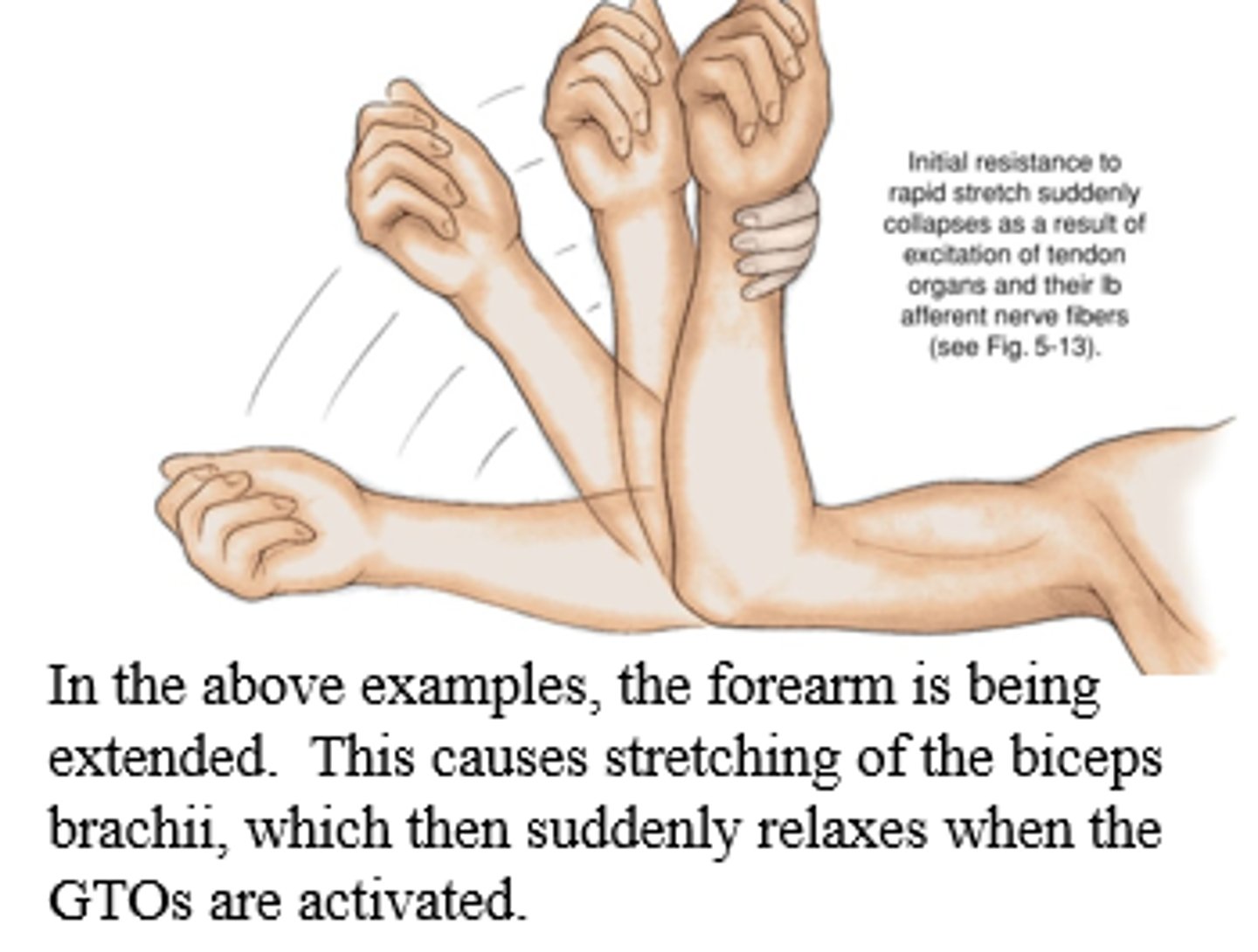 <p>increase muscle resistance gives when passive motion is applied causing limp to close like a pocket knife</p>