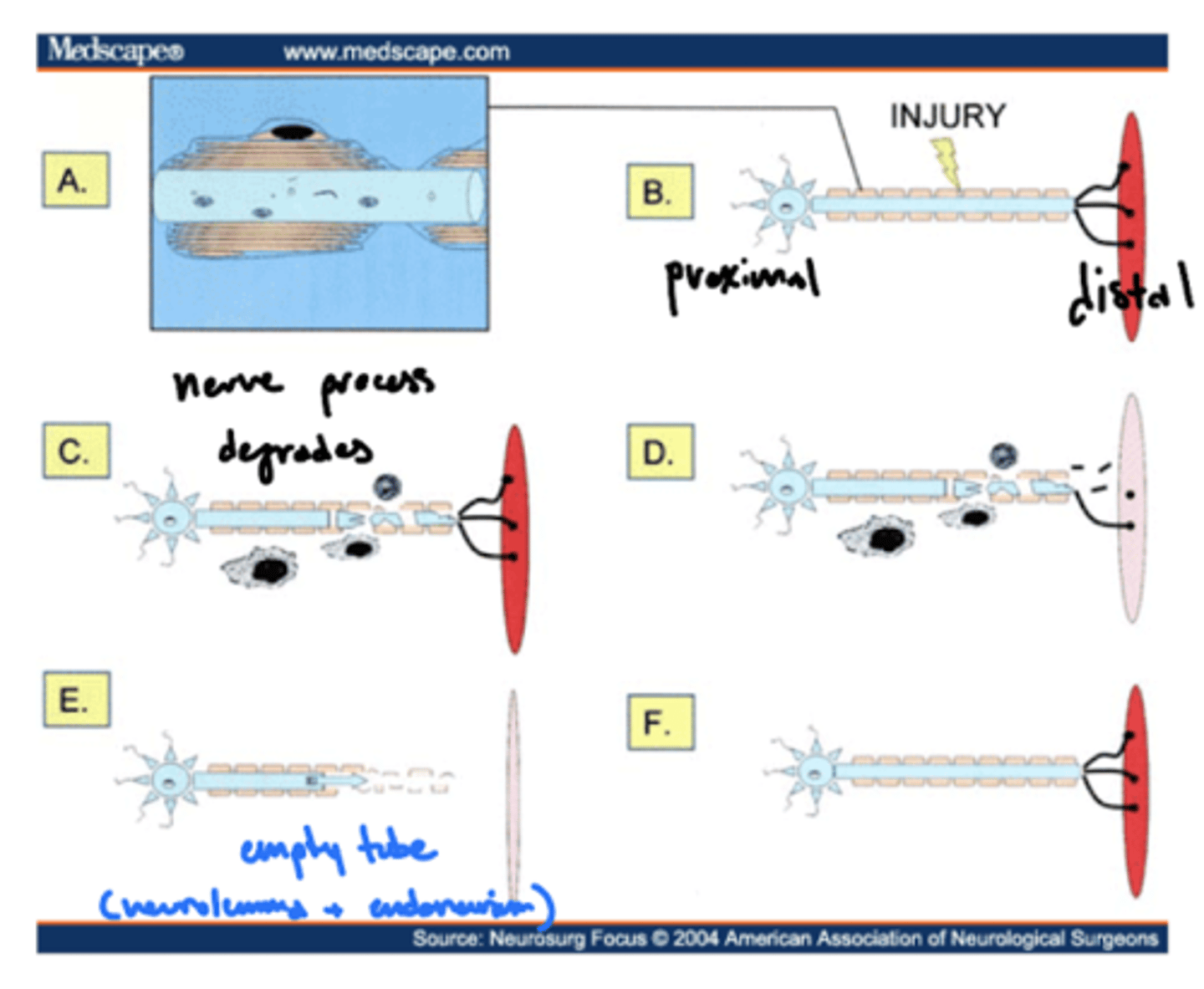 <p>removal of myelin following an injury</p><p>1. Schwann cell intracellular processes</p><p>2. phagocytes to clear neural debris -- leave behind neurolemma/endoneurial tube</p>