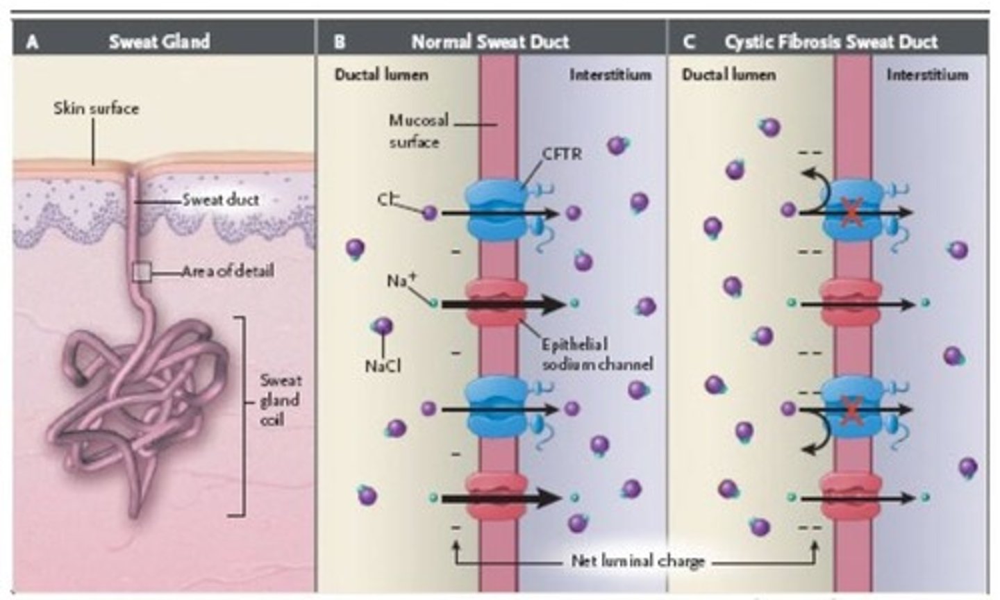 <p>Characteristic of CF due to NaCl reabsorption failure.</p>