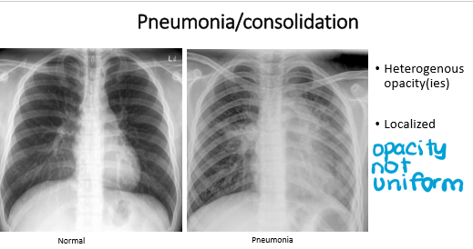 <p>pneumonia</p><ol><li><p>heterogenous</p></li><li><p>localized</p></li></ol><p></p>