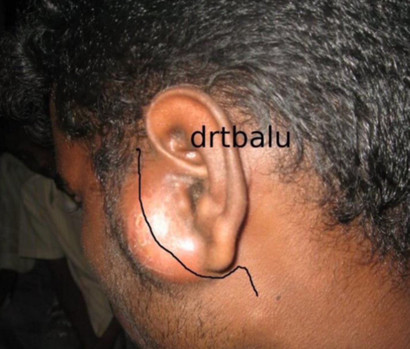 <p>bacterial sialadenitis</p>