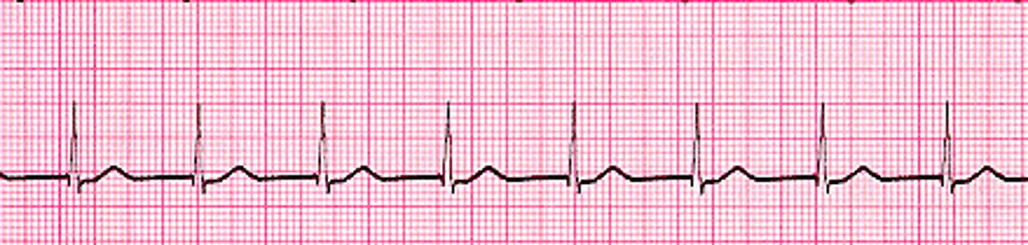 <p>Regular</p><p>Rate: 60-100</p><p>P Wave: NONE or INVERTED</p><p>PR Interval: None or <0.12</p><p>QRS: <0.12 sec</p>