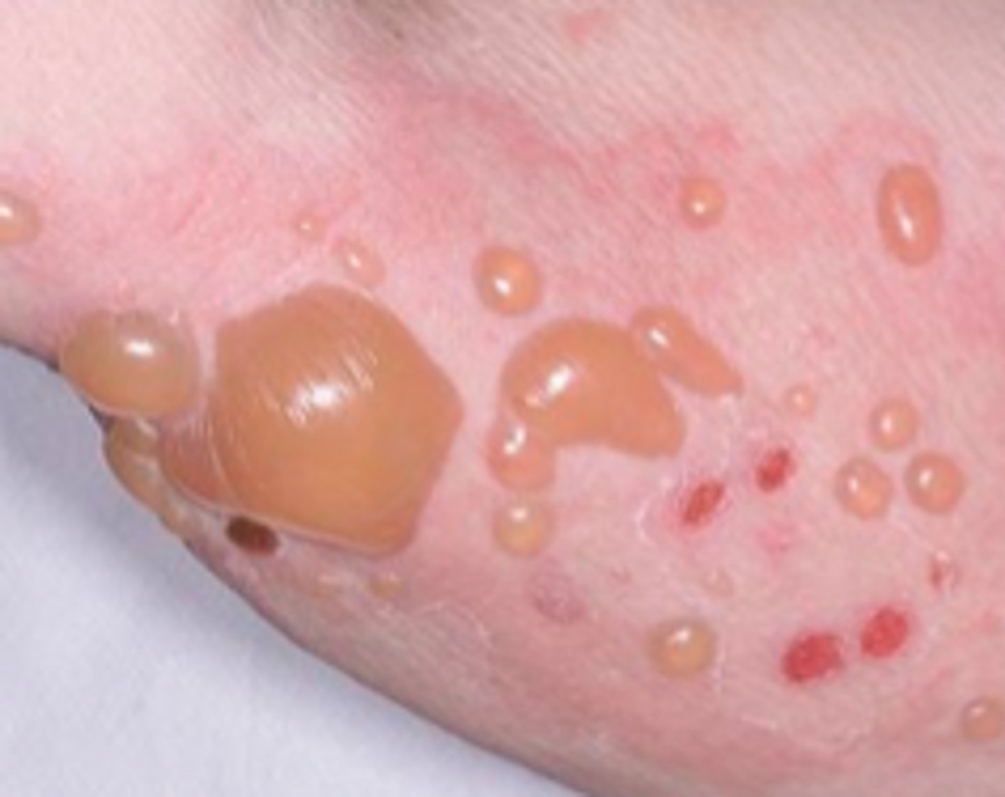<p>- Tense pruritic blisters, widespread bullae, usually in lower trunk, itchy, dense, symmetric</p><p>- negative Nikolsky sign</p><p>- does not effect mucus membranes</p>