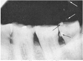 <p>How would you resolve this AIR BUBBLES X-ray?</p>