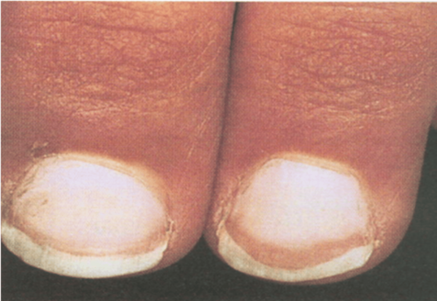 <p>◦Mostly whitish with a band of reddish brown, seen in aging, cirrhosis, CHF, diabetes</p>