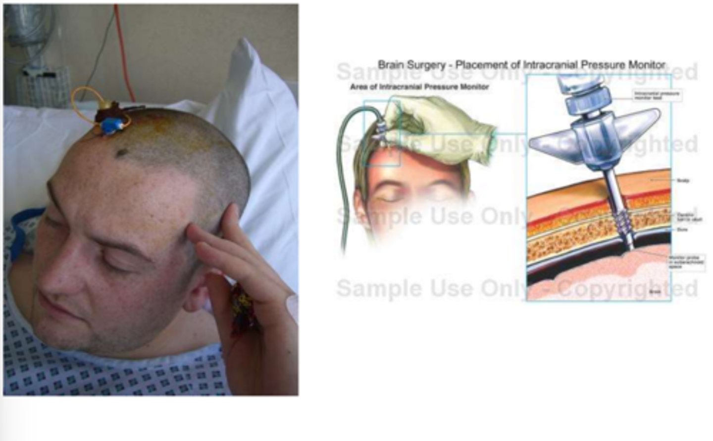 <p>PT Implications for Intracranial Pressure:</p><p>- Momentary elevations in ICP will normally occur, sustained over _______________________ should be reported to an RN</p><p>- HOB &gt;______________________ and avoid neck _______________________ - enhance venous drainage</p><p>- Avoid _____________________, noxious stimuli, isometric contractions</p><p>- Plateau in wave may indicate ______________________</p>
