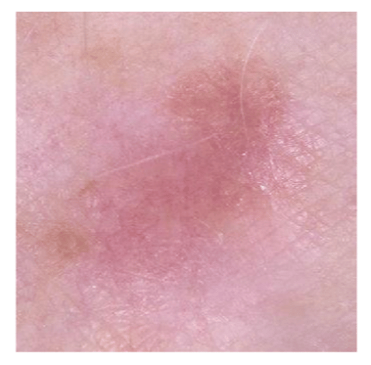 <p>false = can be amelanotic = pinkish/purple/clear and thicker</p>