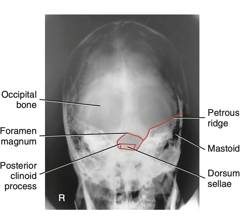 <p>What is <u>best demonstrated</u> for <strong>AP axial projection of Towne’s</strong> method for <strong>skull</strong>?</p>