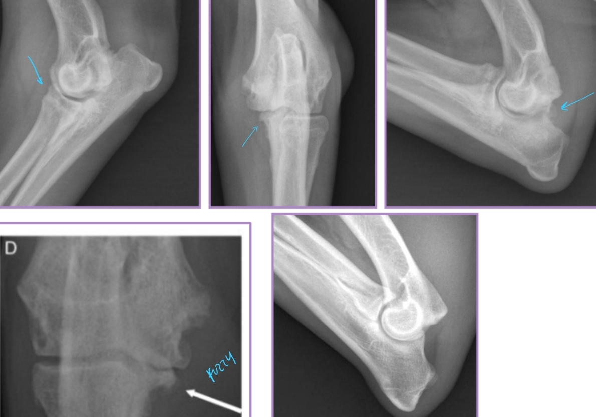 <ul><li><p><strong>Growing/developmental disease</strong>, Bilateral</p></li><li><p><span style="background-color: transparent;"><strong><span>Et:</span></strong><span> </span></span><span style="background-color: transparent; color: red;"><span>Growth incongruency radius/ulna</span></span><span style="background-color: transparent;"><span>, abnormal joint stress, </span><strong><u><span>pressure on medial coronoid of ulna</span></u></strong></span></p></li><li><p><span style="background-color: transparent;"><strong><span>Sig:</span></strong><span> </span><strong><span>Large breed dogs</span></strong><span>, Labs, Bernese Mountain Dog, Male > Female, </span></span><span style="background-color: transparent; color: red;"><strong><span>6-18 months</span></strong></span></p></li><li><p><span style="background-color: transparent; color: red;"><strong><span>Cs:</span></strong><span> OA, Lameness with ambulation, </span><strong><span>Decreased ROM of elbow joint</span></strong><span>, </span><strong><u><span>Pain(PE/palpation)</span></u></strong><span>, Minimal joint effusion, Muscle atrophy</span></span></p></li><li><p><span style="background-color: transparent;"><strong><span>Dt: Lateral, AP, </span><u><span>flexed</span></u><span>, Crlat-oblique</span></strong></span></p><ul><li><p><span style="background-color: transparent;"><strong><span>Rads:</span></strong><span> </span></span><span style="background-color: transparent; color: red;"><strong><u><span>Osteophytes(back of elbow)</span></u></strong></span><span style="background-color: transparent;"><span>, Effusion, Subtrochlear sclerosis, Joint incongruity</span></span></p></li><li><p><span style="background-color: transparent;"><strong><span>CT: </span></strong><u><span>Most sensitive</span></u><span> </span></span></p></li></ul></li></ul><ul><li><p><span style="background-color: transparent;"><strong><span>Tx: Rx:</span></strong><span> Management of OA</span></span></p><ul><li><p><span style="background-color: transparent;"><strong><span>Sx: gold standard </span></strong></span></p></li><li><p><span style="background-color: transparent;"><strong><span>Medial arthrotomy:</span></strong></span></p><ul><li><p><span style="background-color: transparent;"><strong><span>Cons:</span></strong><span> Limited view, high postoperative morbidity</span></span></p></li><li><p><span style="background-color: transparent;"><strong><span>Arthroscopy (#1): gold standard</span></strong></span></p></li><li><p><span style="background-color: transparent;"><strong><span>Pro:</span></strong><span> Min invasive, good view</span></span></p></li><li><p><span style="background-color: transparent;"><strong><span>Cons:</span></strong><span> higher cost, learning curve</span></span></p></li></ul></li></ul></li></ul><p></p>