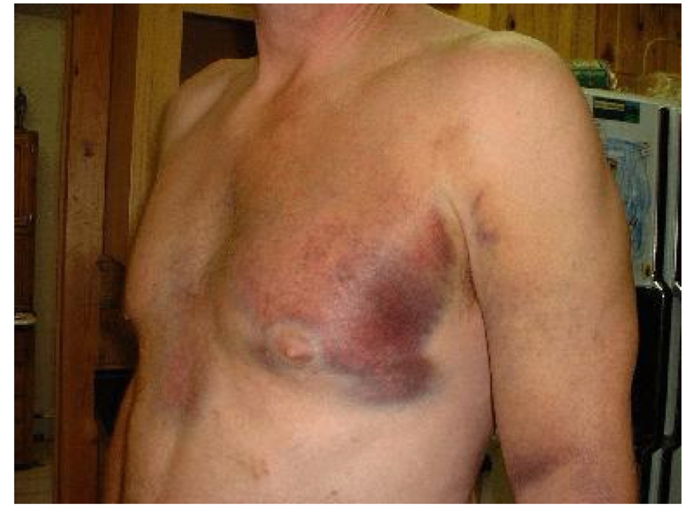 <p>what type of skin lesion is this? </p>