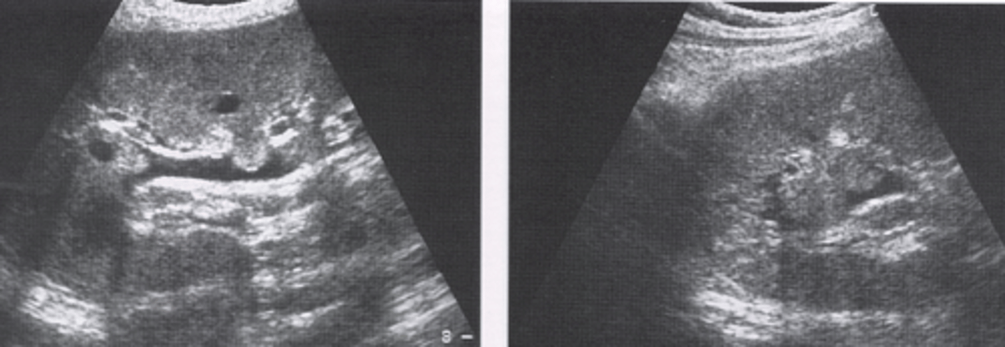 <p>-fluid spaces at coritical medullary junction corresponding to pyramid distribution</p><p>-round or triangular shaped</p><p>-mimic calculi</p>