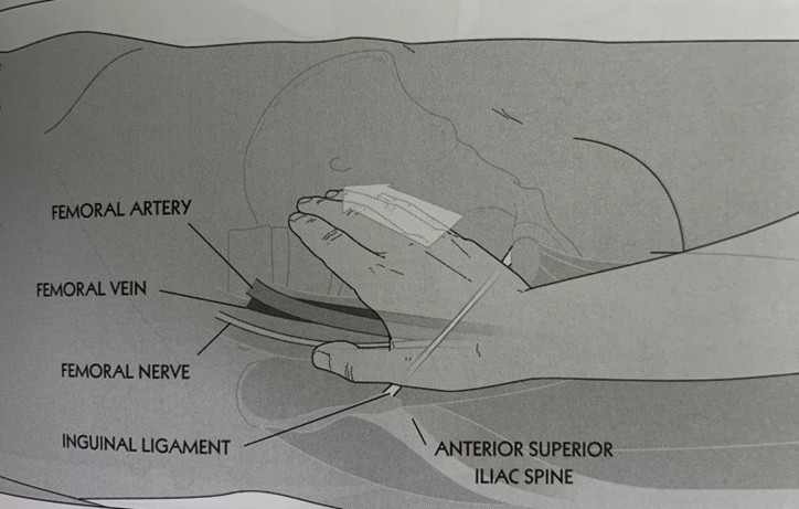 <p>Position – Supine</p><p>Contact the middle of the inguinal ligament with the hypothenar eminence.  Force is in a superior, medial and posterior direction.</p><p>Maintain a steady pressure until a release is felt.</p>