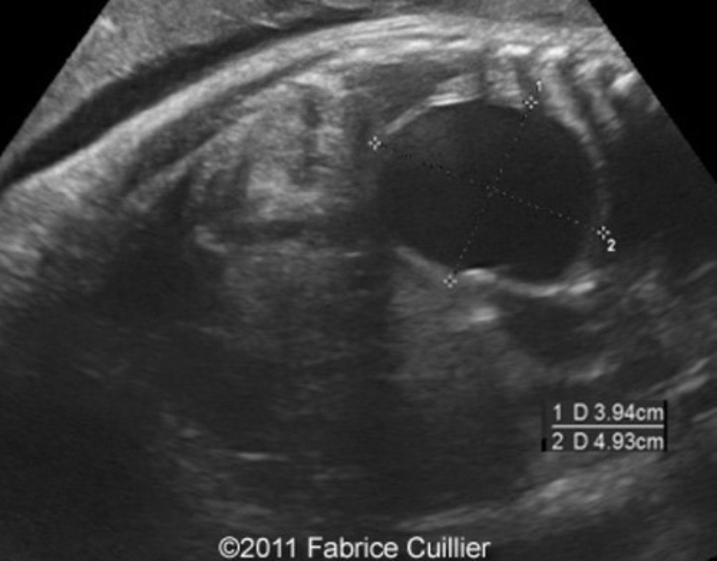 <p>Cyst within lung tissue</p>