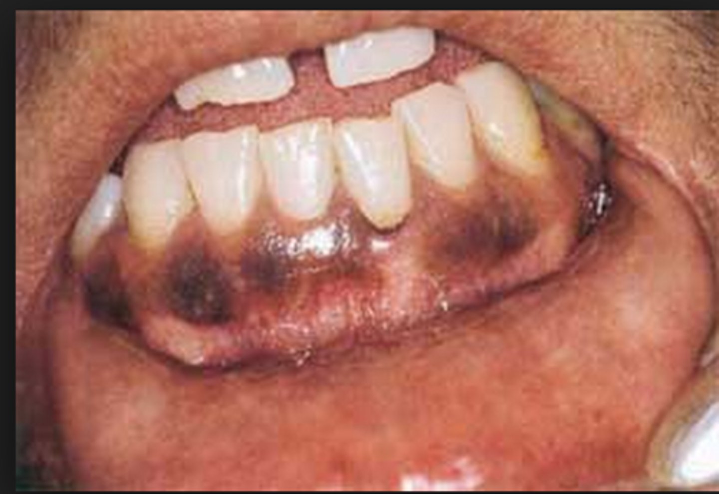 <p>normal pigmentation of gingiva </p><p>• Population: dark-skinned patients</p>
