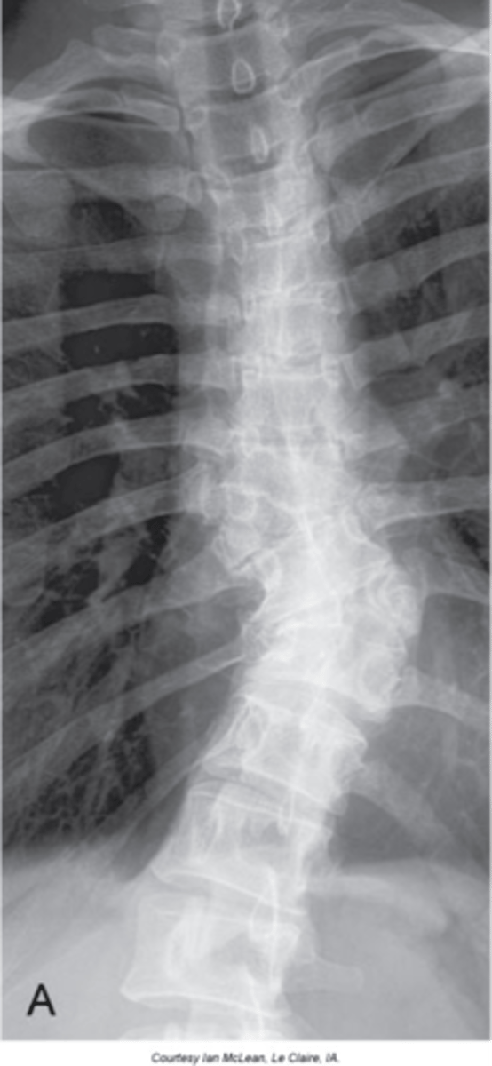 <p>- Failure of ossification and, at times, segmentation of a vertebrae</p><p>- Most commonly they are lateral, but anterior and posterior ones do occur</p>