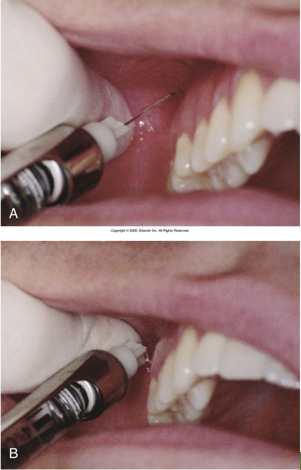<ul><li><p>Height of mucobuccal fold above the maxillary second molar</p></li><li><p>45 degree angle</p></li><li><p>Landmarks: mucobuccal fold, maxillary tuberosity &amp; zygomatic process of the maxilla</p></li><li><p>27 gauge SHORT needle</p></li><li><p>Deposit over 30-60 sec</p></li></ul><p></p>