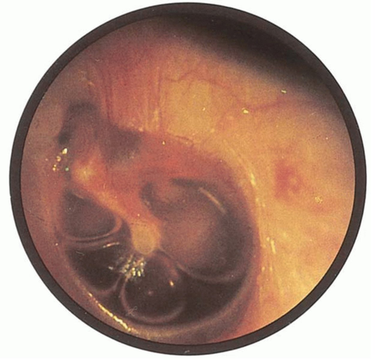 <p>collection of amber serous fluid behind the TM</p><p>-associated with URI, can lead to acute OM</p>