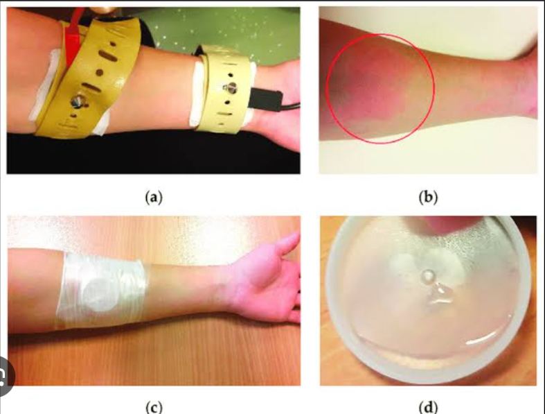 <ul><li><p>It measures the concentration of sodium in sweat after stimulation of the sweat glands with topical pilocarpine; low-voltage current is applied to aid in the absorption of the pilocarpine. </p></li><li><p>It is used in the diagnosis of <strong><em>cystic fibrosis</em></strong>.</p></li></ul>
