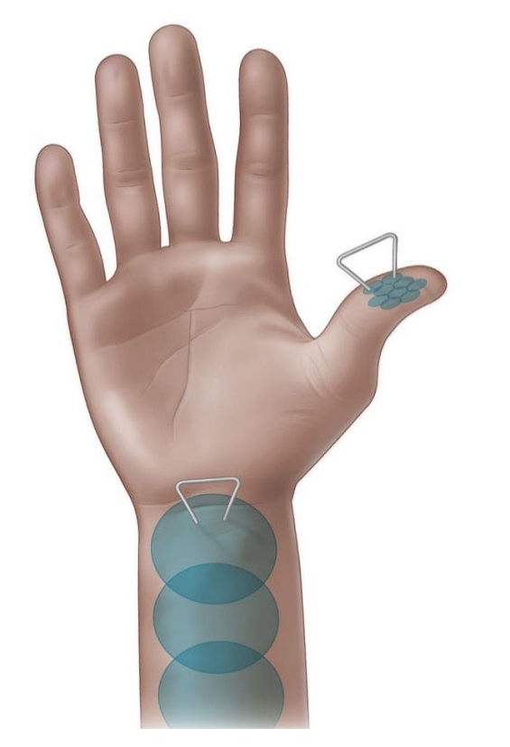 <ul><li><p>The minimum distance at which two stimuli (e.g., two simultaneous touches) are just perceptible as separate</p></li><li><p>Ex.</p><ul><li><p>If someone lightly touches your&nbsp;<strong>fingertip</strong>&nbsp;with two toothpicks that are&nbsp;<strong>1 mm apart</strong>, you might feel&nbsp;<strong>two distinct points</strong>.</p></li><li><p>But if they do the same on your&nbsp;<strong>back</strong>, you might not feel them as separate unless they’re&nbsp;<strong>3–5 cm apart</strong>.</p></li></ul></li></ul><p></p>