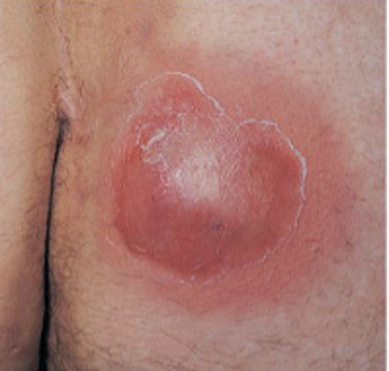 <p>focal suppurative infection of central hair shaft and surrounding subcutaneous tissue</p>