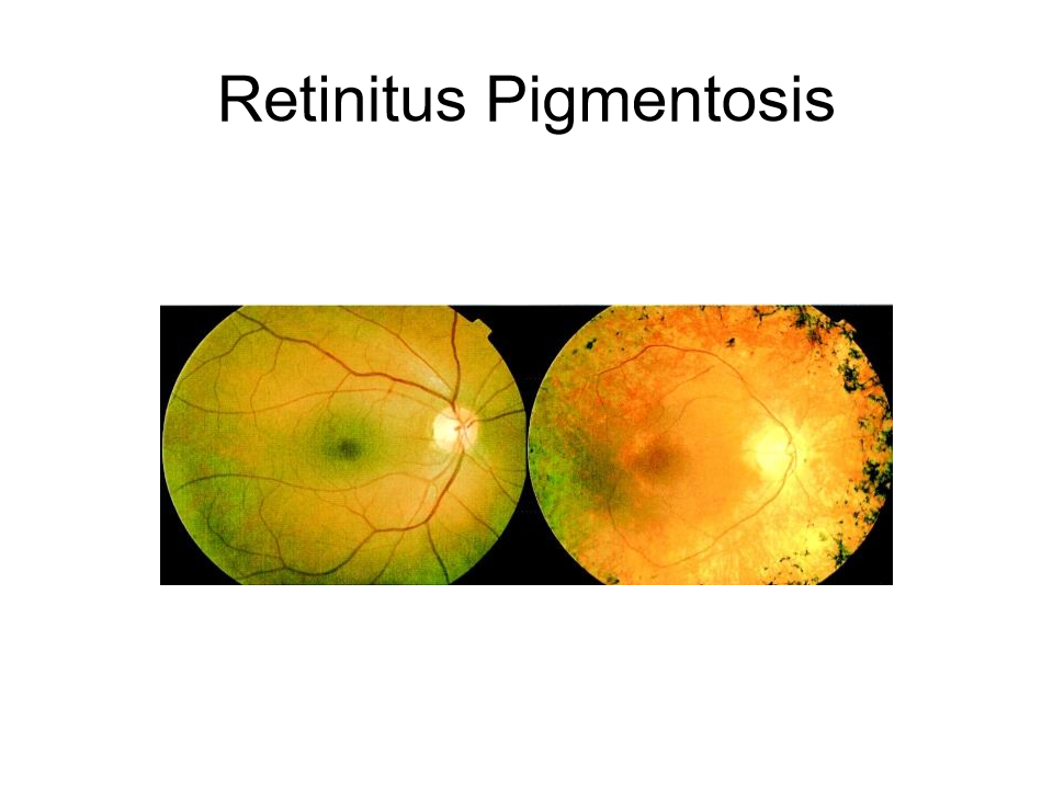 <p>retina looks like a different colour </p>