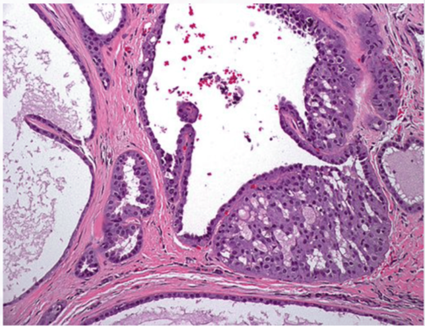 <p>-Bland cytology</p><p>-Varying appearances</p><p>▫ "hobnail" cells</p><p>• Translocation!▫ ETV6-NTRK3 ⇒t(12;15)(p13;q25)</p>