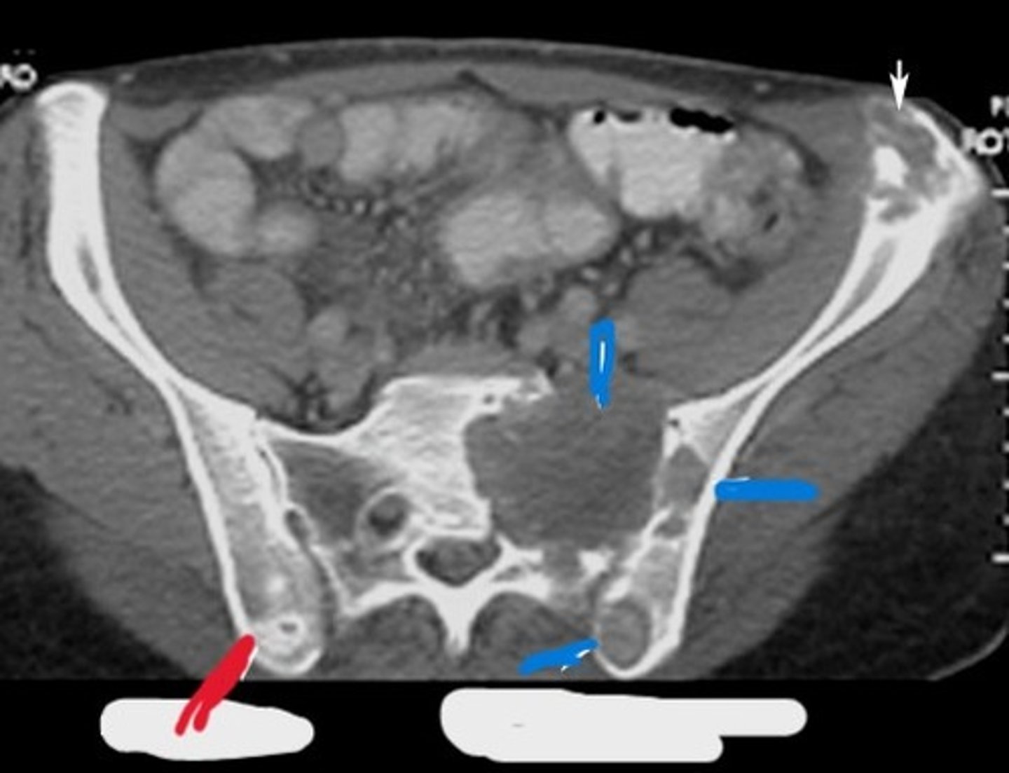 <p>What type of pathology is the red line pointing to and what type of pathology is the blue line pointing to</p>