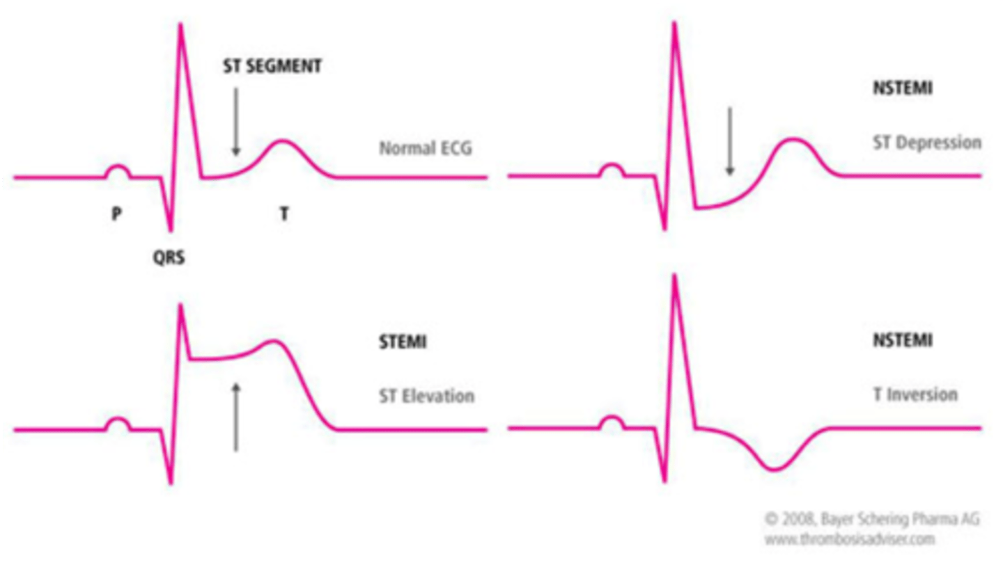 <p>ST elevation myocardial infarction</p><p>(complete blockage of flow and profound ischemia)</p>