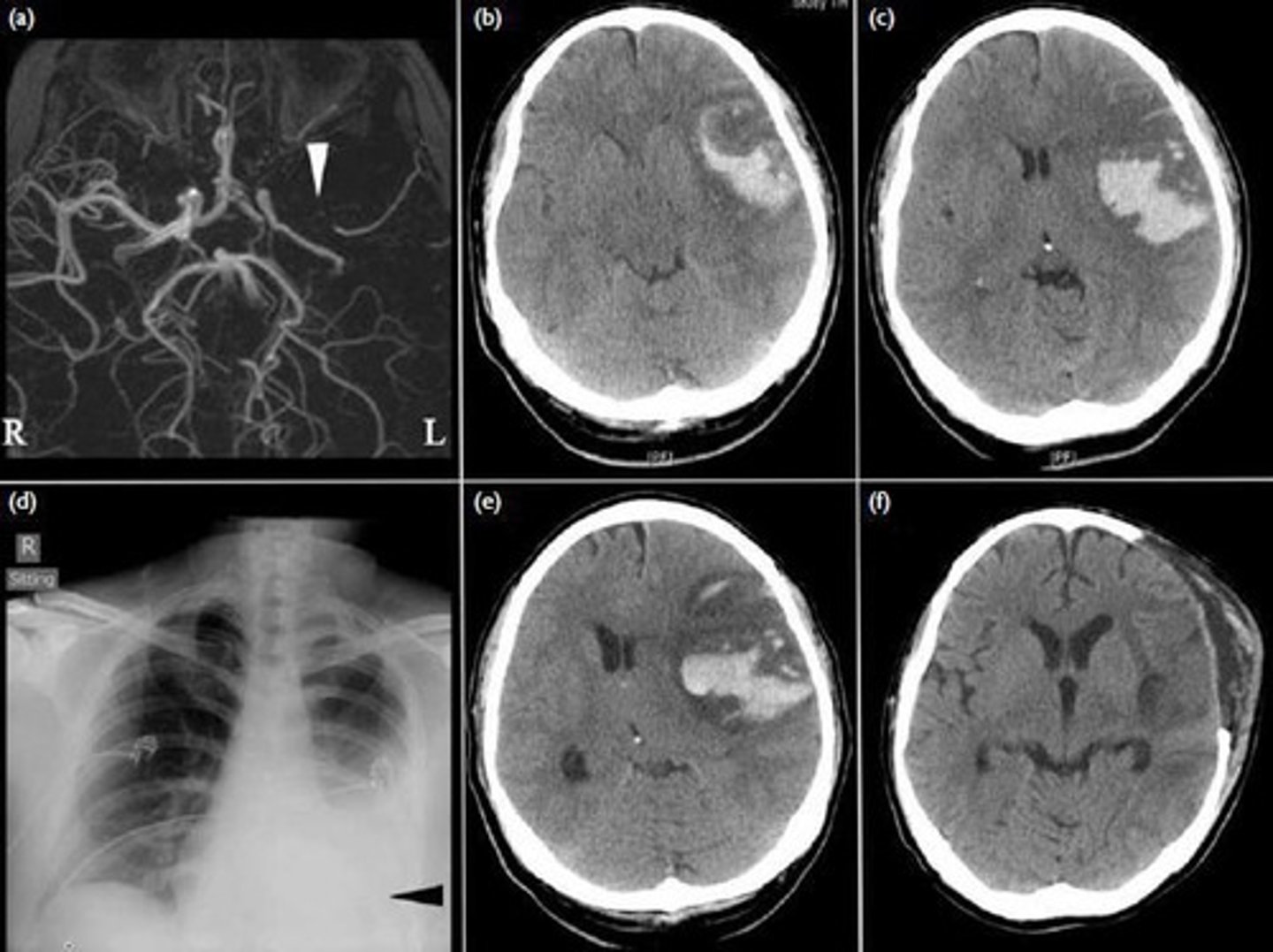 <p>A stroke caused by the rupture of a cerebral blood vessel.</p>