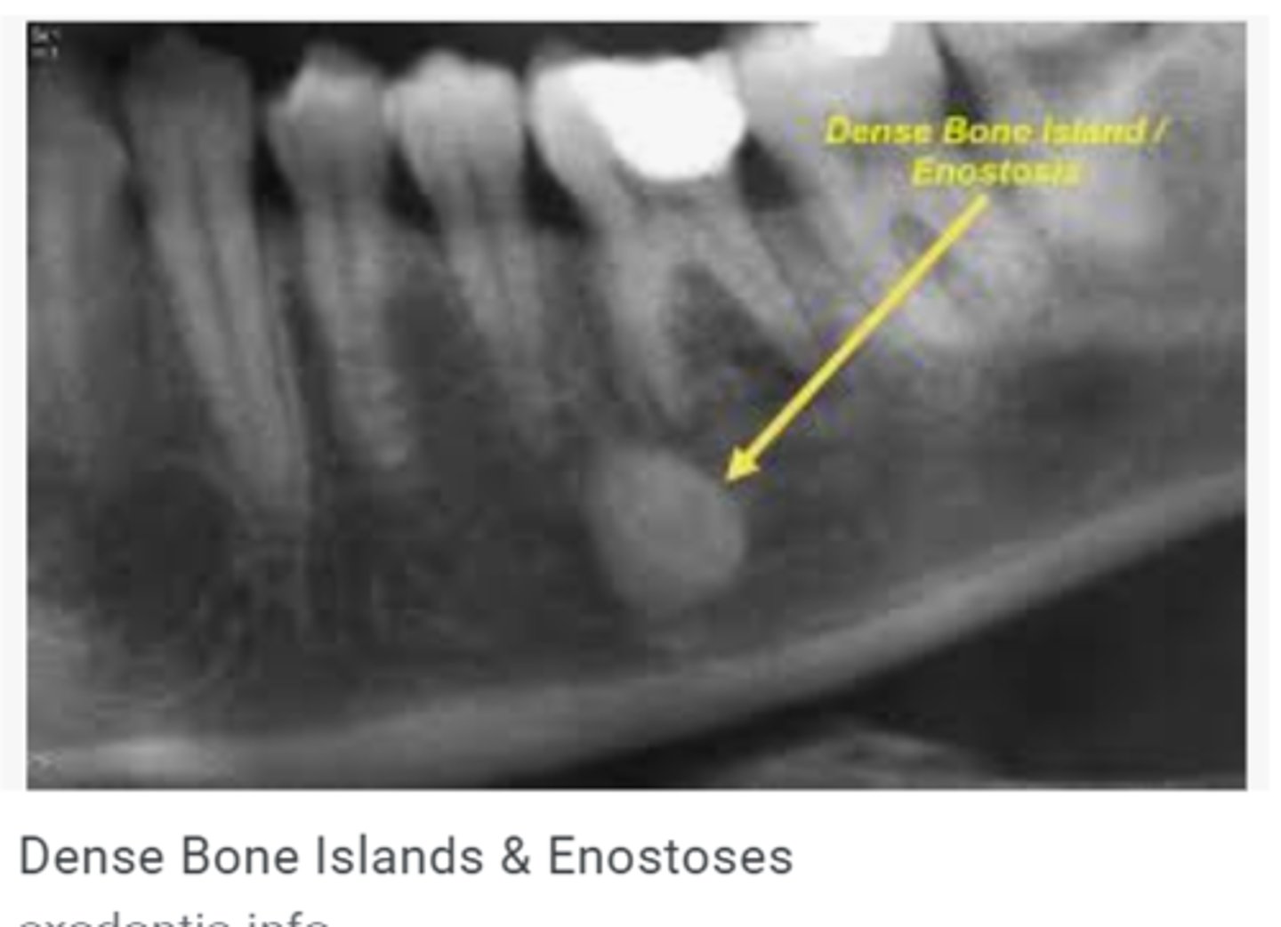<p>Dense bone island</p>
